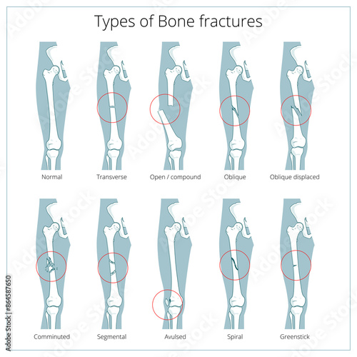Types of bone fractures medical skeleton anatomy educational PNG illustration. Medical science