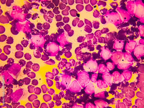 Multiple Myeloma Awareness: Bone marrow aspirate cytology of multiple myeloma, a type of bone marrow cancer of malignant plasma cells.
