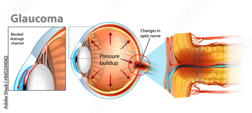 Glaucoma is a group of eye diseases that lead to damage of the optic nerve. Intraocular pressure in the back of the eye