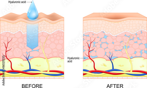 Hyaluronic acid. Skin rejuvenation