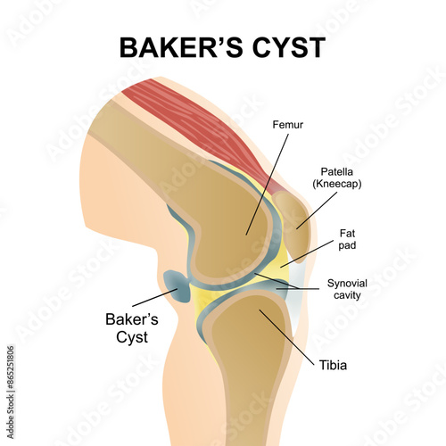 Bakers cyst knee illustration c-section
