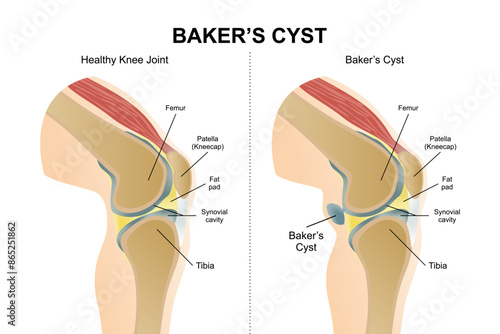 Normal and Bakers cyst knee illustration