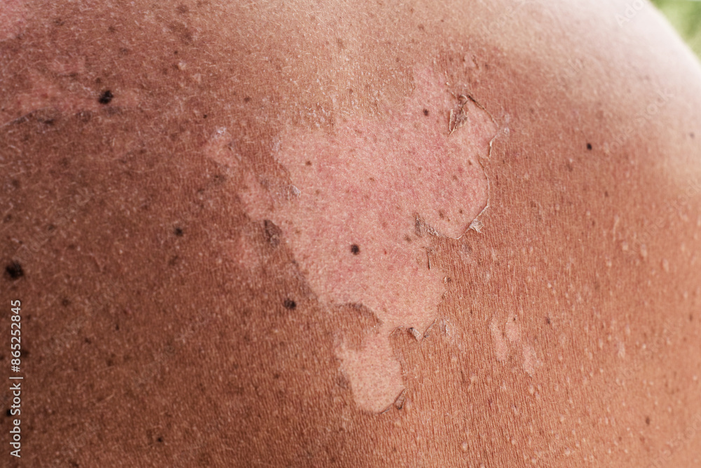 Fototapeta premium Close-up of a male back with peeling skin due to sunburn