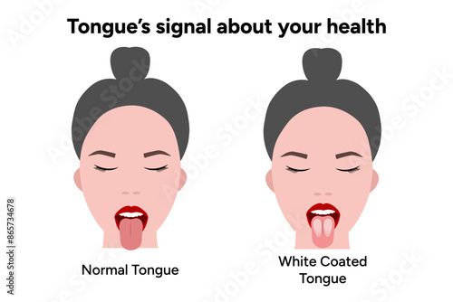 White coated tongue and normal tongue 