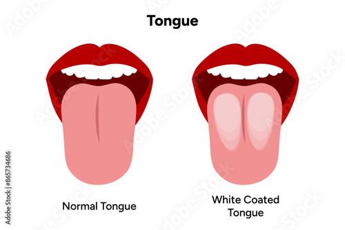 White coated tongue and normal tongue 
