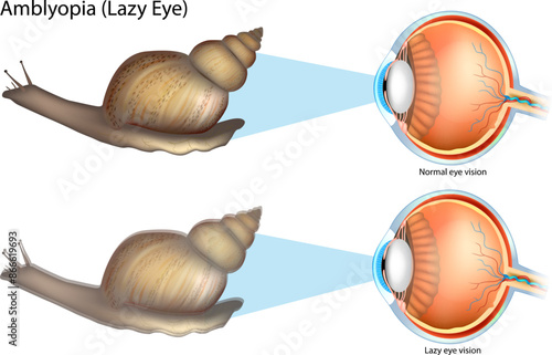 Amblyopia or Lazy Eye. Lazy eye vision and Normal eye vision