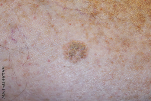 Close-up of a skin with many moles and one dysplastic nevus or atypical mole. This is a mole larger than normal with a higher risk to become a melanoma