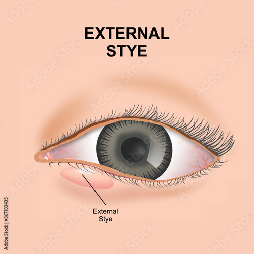 External Stye (Sty) eye illustration