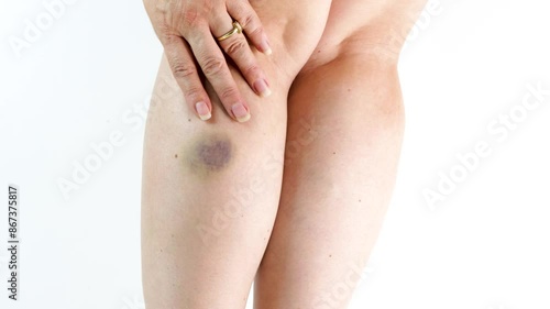 A tremendous superficial bruise on a girl leg, isolated on white background