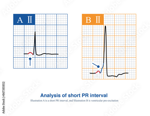 When a short PR interval is found on the electrocardiogram, careful observation of the beginning of the QRS wave can reveal whether it is ventricular preexcitation. photo