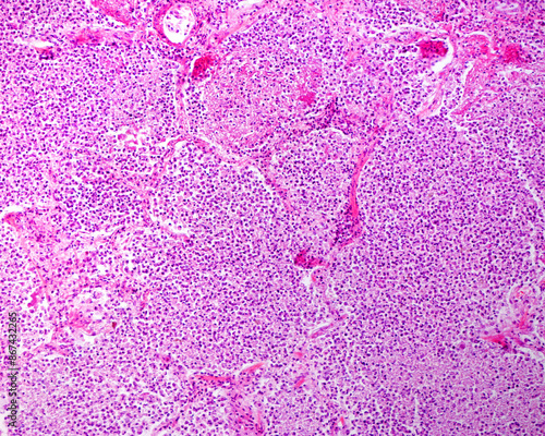 Human lung. Acute pneumonia photo