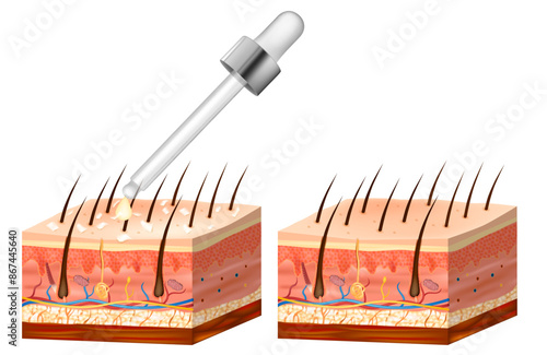 Seborrhoeic dermatitis. Before and after treatment.