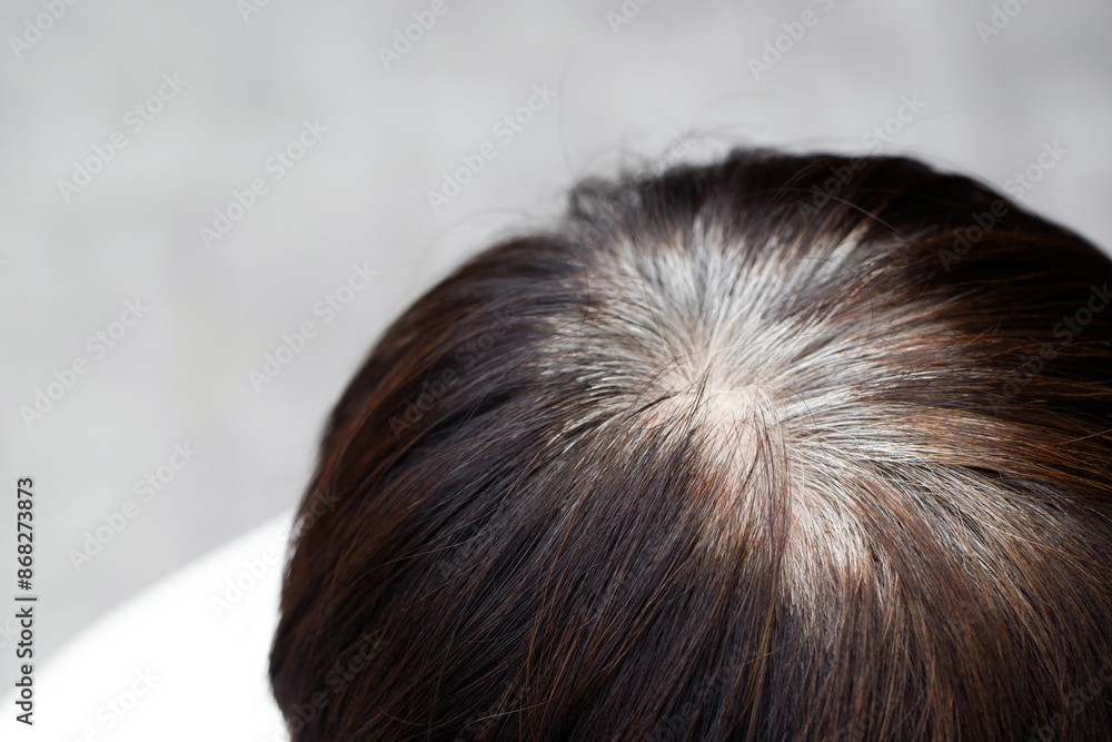Back view of young people premature gray hair, showing black hoary hair roots on head change to senior old man outdoor. Back view of young people premature gray hair, showing black hoary hair roots on head change to senior old man outdoor.