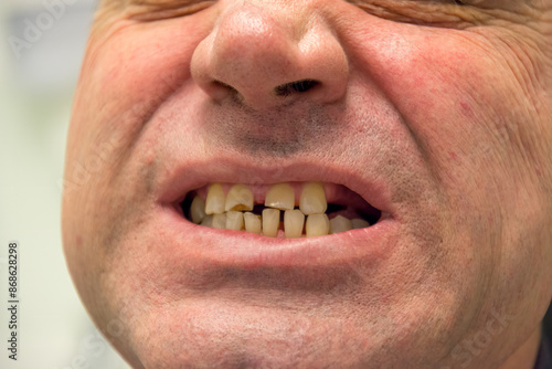 Close-up of a male patient's mouth showing damaged teeth BEFORE dentures. The man is missing some teeth and his teeth are very worn. Real photo from the series. There are before and after photos.