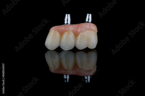 Dental bridge four teeth and artificial gum made of monolithic zirconium for fixation on implants photo