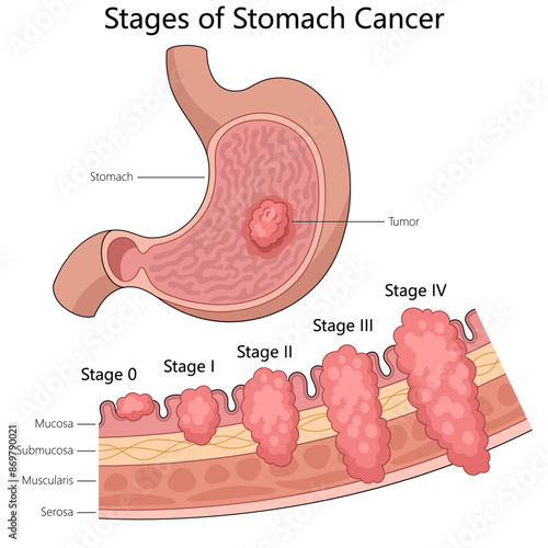 progression stages of stomach cancer from stage 0 to stage IV, highlighting tumor growth diagram hand drawn schematic vector illustration. Medical science educational illustration