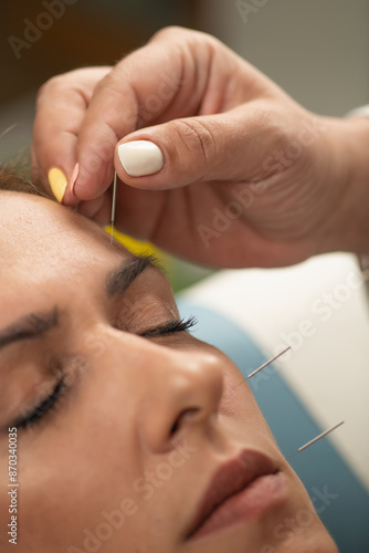 Acupuncture Treatment for Nervus Facialis photo