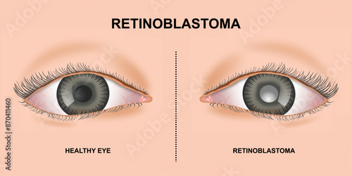Retinoblastoma Eye Cancer Realistic Illustration