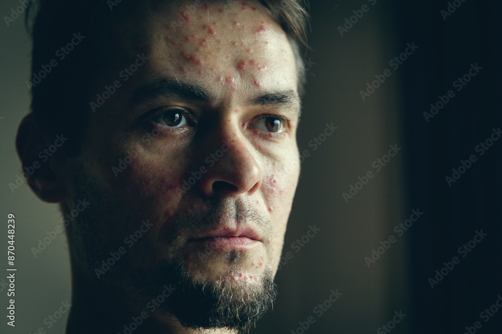 Fototapeta premium Portrait of an adult man with a rash on his face in the form of red dots, this is what symptoms of any smallpox look like, for example chickenpox.