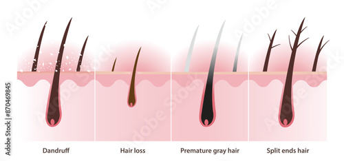 The cross section of hair problems with scalp layer vector illustration on white background. Dandruff, white dry flaky, scaly scalp, hair loss, alopecia, premature gray hair and split ends hair.