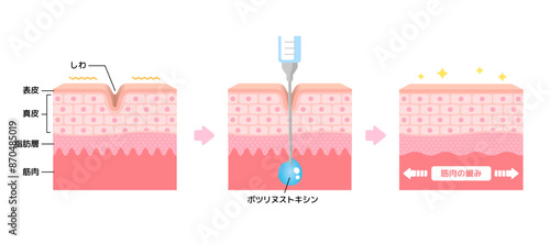 ボトックス注射 (ボツリヌストキシン）によるシワ取りのメカニズム / ベクター図解イラスト