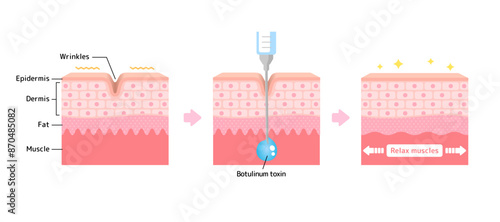 Mechanism of wrinkle improvement with botulinum toxin injection