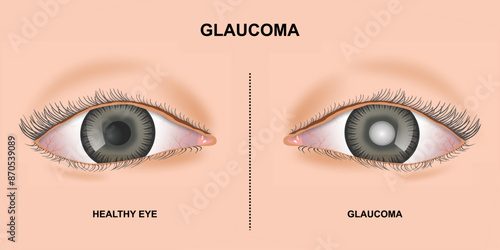Glaucoma vs Healthy Eyes Illustration