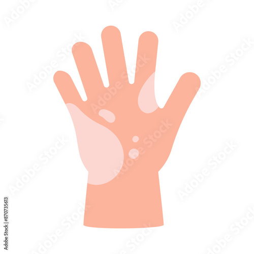 Vitiligo on skin of hand of child. Body with area pigmentation different color. Autoimmune disease. Vector
