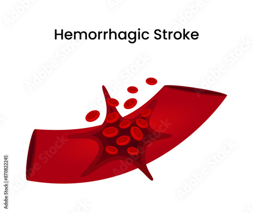 Hemorrhagic Stroke Cerebral Blood Vessel Rupture