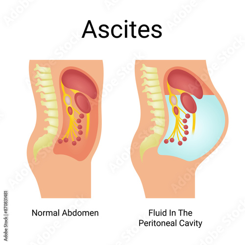Vector Illustration of Normal Abdominal Ascites and Fluid in Peritoneal Cavity