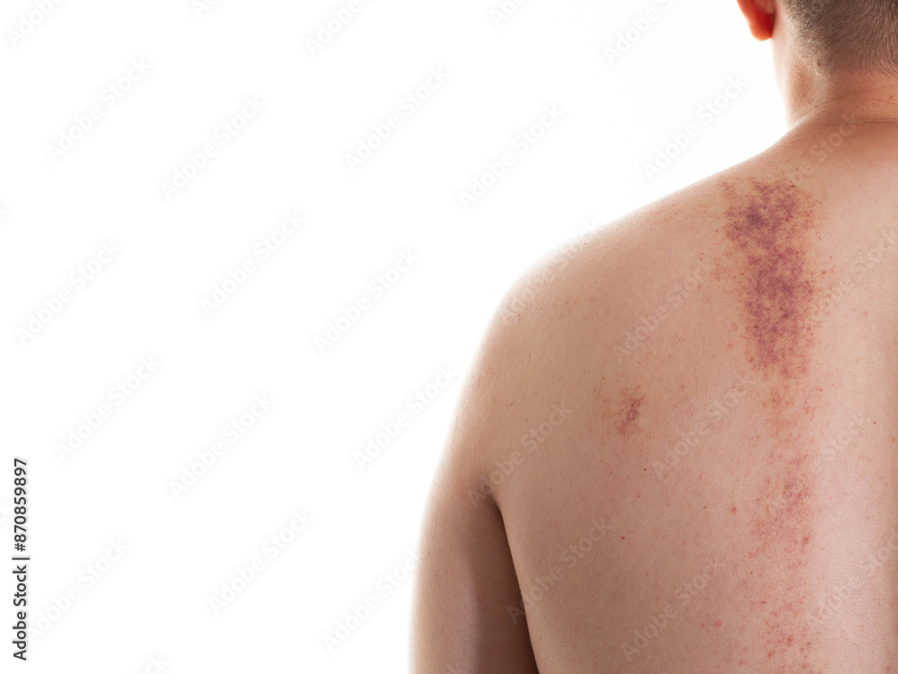 Naklejka premium The skin of a man's back with red spots, marks on the skin and bruises after improper massage, close-up. Copy space for text