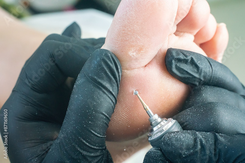 Fotografia A podologist removes a rod callus on a woman's foot with an electric pedicure dr