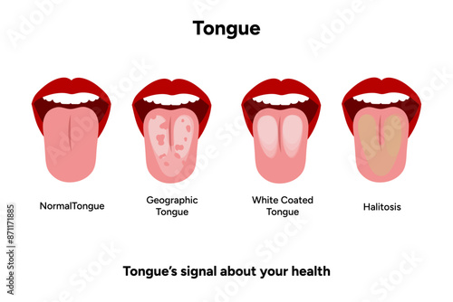 Normal, geographic, white, and halitosis tongues