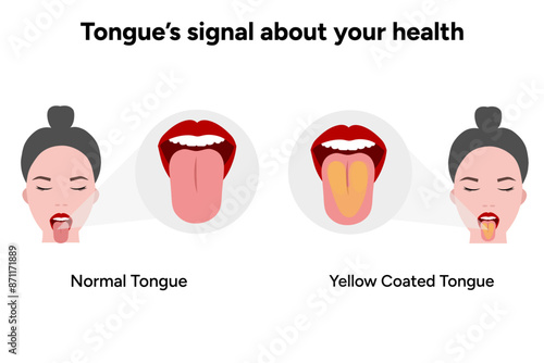 Normal and Yellow coated tongue