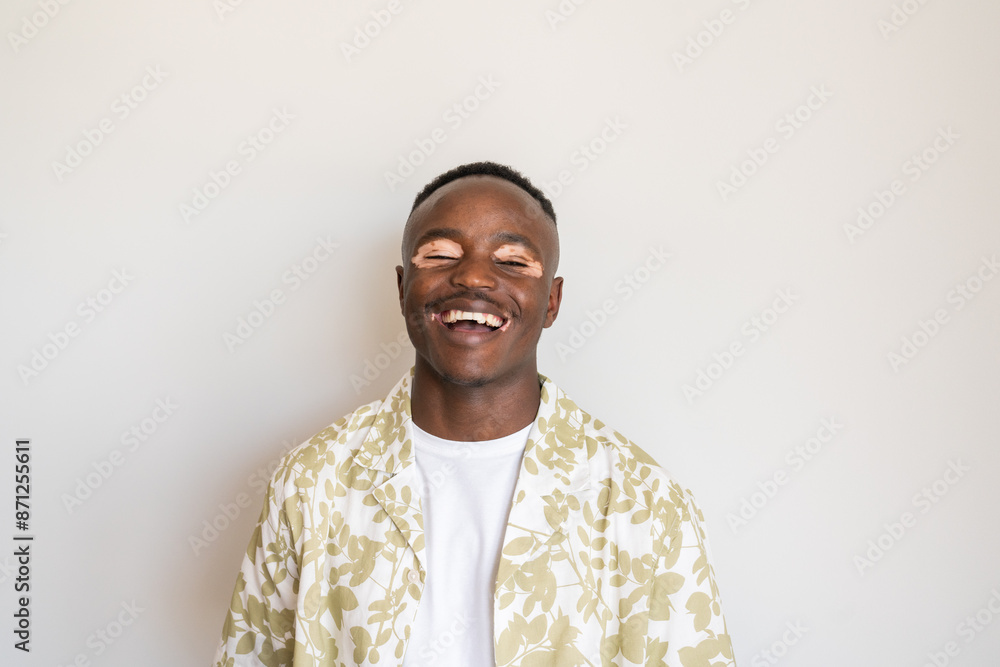 Cheerful Man With Vitiligo Skin Condition Portrait
Cheerful Man With Vitiligo Skin Condition Portrait