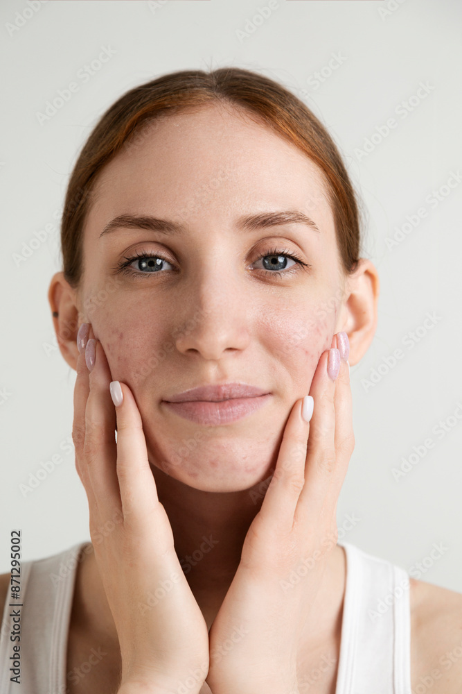 Young Woman with Acne Touching Her Face
Young Woman with Acne Touching Her Face