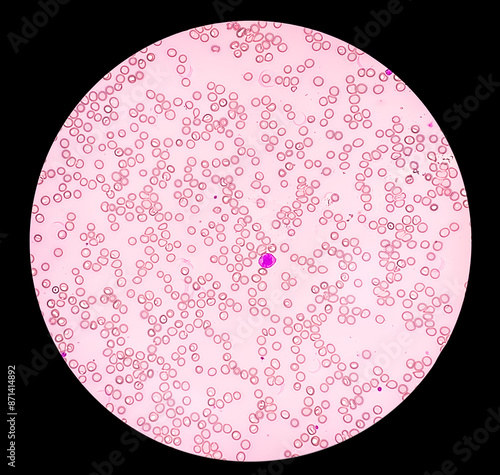 Photomicrograph showing Aplastic anemia, a rare but serious blood condition that occurs when bone marrow can not make enough new blood cells in body. photo