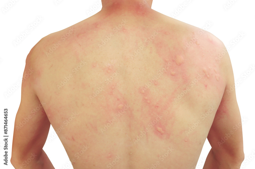 Murais de parede Allergy back skin with rash and itchy bump