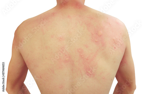 Foto Allergy back skin with rash and itchy bump