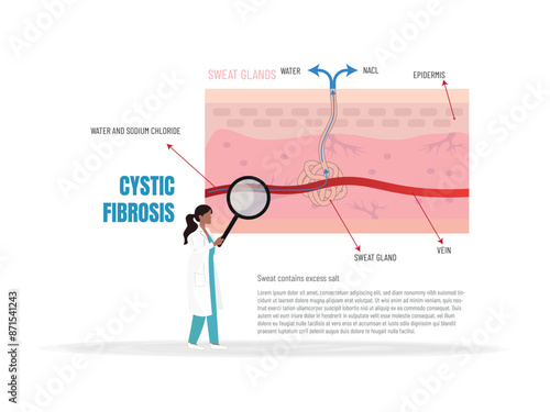 A woman is looking at a diagram of the body with a cystic fibrosis. The diagram is labeled with the name of the disease and the woman is wearing a white lab coat.