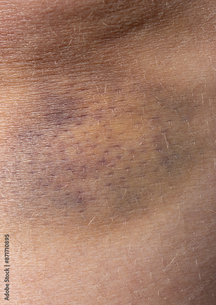 hematoma on the leg as a background. hematoma on the leg as a background.