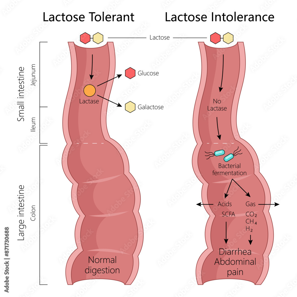 Lactose Tolerance And Intolerance Normal Digestion With Lactase And 