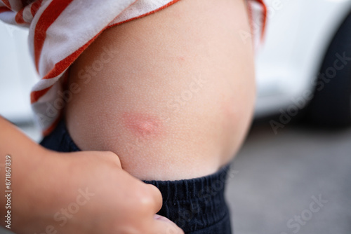 The child lifts his shirt to examine the mosquito bite. There is severe redness at the site of the bite.