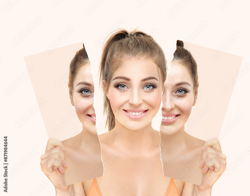 Skin problems .. Before- After,Portrait of beautiful girl  with problem and clear skin