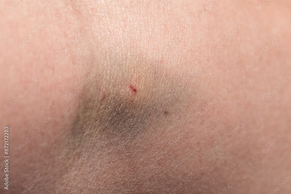 A human hand with a hematoma and traces of injections into a vein A human hand with a hematoma and traces of injections into a vein