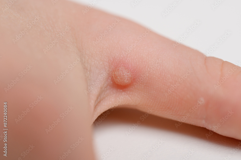 Close-up of common wart Verruca vulgaris on child hand. Large flat wart on finger. HPV infection. Wart removal concept Close-up of common wart Verruca vulgaris on child hand. Large flat wart on finger. HPV infection. Wart removal concept