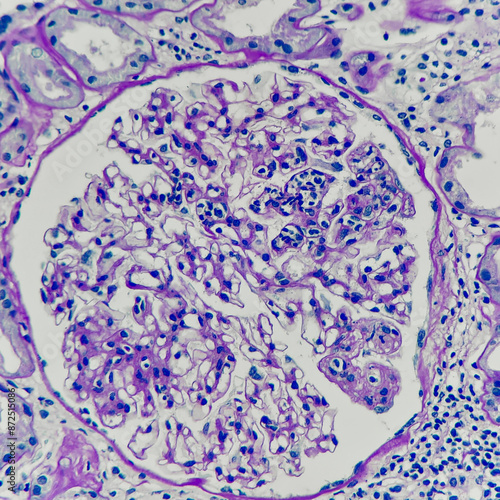 Camera photo of a glomerulus showing segmental endocapillary hypercellularity, magnification 400x, photograph through a microscope