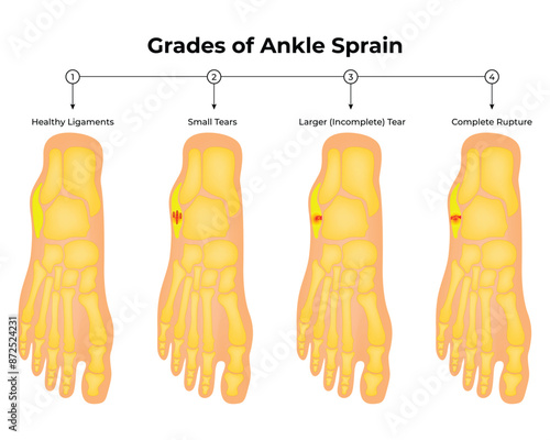 Grades of Ankle Sprin Science Design Vector Illustration Diagram