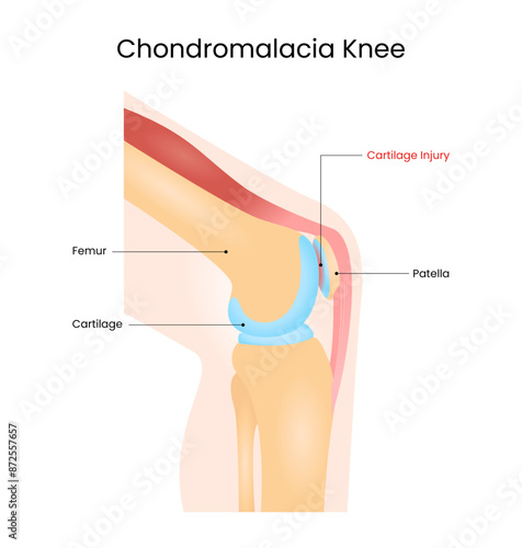 Chondromalacia Patella Knee Pain Vector