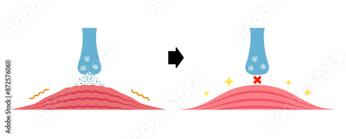 Mechanism of muscle relaxation by Botox. Vectror illustration.